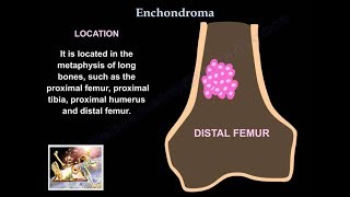 Vascular tumors  Angiosarcoma  Definition Epidemiology Pathology Diagnosis and treatment [upl. by Terrag637]