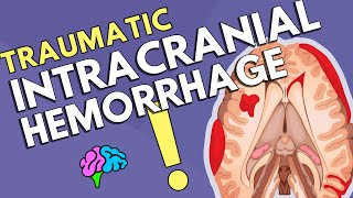 Intracranial Hemorrhage [upl. by Jim75]