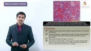 Kaposi Sarcoma DermatologyPathology Collaboration by globaldermie amp JMGardnerMD [upl. by Teyut]