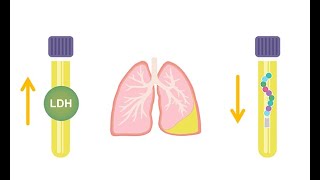 Differentiating transudative and exudative effusions transudate vs exudate [upl. by Nylitsirk]