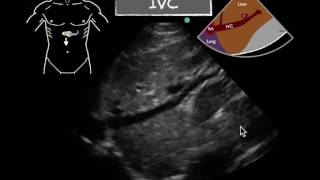 Inferior Vena Cava Collapsability [upl. by Ramsey]