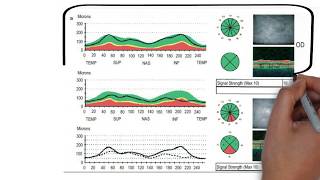 Optical Coherence Tomography  OCT  part1 [upl. by Eolande]