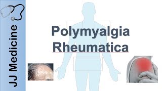 Polymyalgia Rheumatica  Signs amp Symptoms Diagnosis and Treatment [upl. by Mercy]