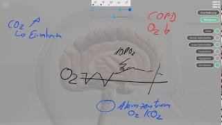 Vorsicht COPD und Sauerstoff [upl. by Amehsat]