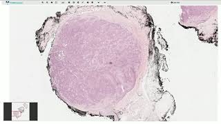 Glomus Tumor  Histopathology [upl. by Ritz]