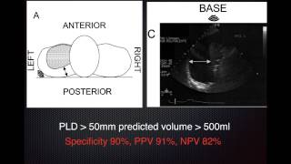 UltrasoundGuided Peripheral IV Insertion  BAVLS [upl. by Monahan775]