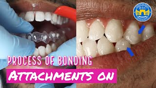 How Invisalign Attachments are placed [upl. by Richarda529]