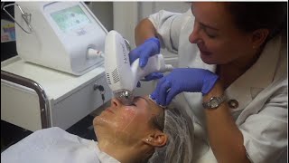 Review of Tixel skin resurfacing treatment for wrinkles and sagging eyelids [upl. by Niven]