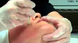 Dermapen Micro Needling Treatment [upl. by Namolos]