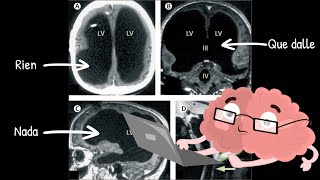 Lhomme au cerveau creux 🧠 la plasticité cérébrale [upl. by Bello]