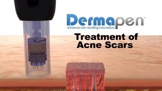 MicroNeedling for Acne Scars  Dermapen® Treatment [upl. by Nyrb]