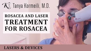 Rosacea and laser treatment for rosacea [upl. by Conlin366]