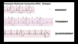 EKG Patterns  Premature Atrial amp Ventricular Contractions PACs amp PVCs [upl. by Jephthah]