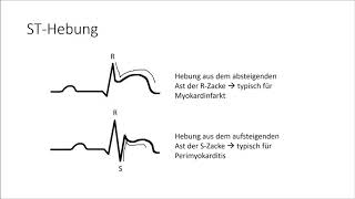 EKG verstehen die Grundlagen EKG Crashkurs Teil 1 [upl. by Auop434]