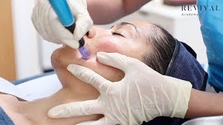 Microneedling Full Training Video [upl. by Esbensen903]