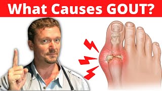 What Causes GOUT Meat Doesnt Cause Gout 2024 [upl. by Ahsieym374]