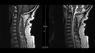 Noncontrast MRI cervical spine search pattern [upl. by Hartzke]