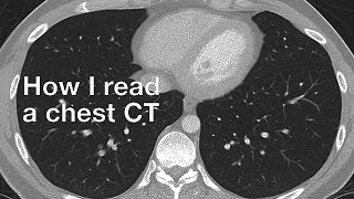 How I Read a Chest CT [upl. by Labanna680]