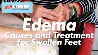 5 Ways to Get Rid of Edema [upl. by Neersin]