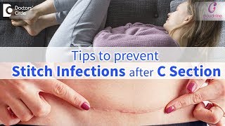 CSection Stitch InfectionsSigns Prevention amp Treatment  Immediate CareDrShashikala Hande of C9 [upl. by Vocaay]