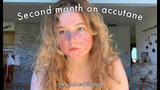 Accutane Journey  month 2 [upl. by Senior]