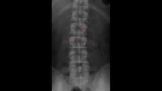 Lumbar Spine Radiology Tutorial [upl. by Maddi881]