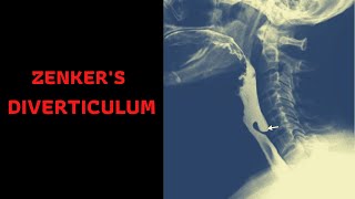 ZENKERS DIVERTICULUM Symptoms Causes TreatmentComplications [upl. by Anasus]