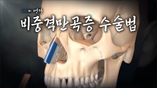 명의 의학백과📖 비중격만곡증 수술법 [upl. by Leamhsi]