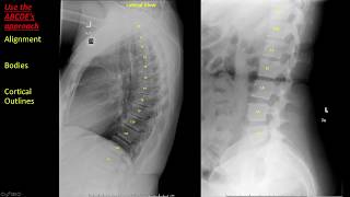 Introduction to Spine Radiographs [upl. by Onitrof]