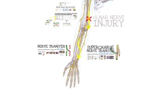 Supercharge Endtoside Nerve Transfers Feat Dr Mackinnon [upl. by Zendah374]