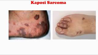 Kaposi sarcoma [upl. by Ahset]