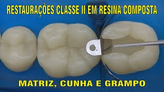 Restauração Classe II em Resina Composta  PARTE 1 [upl. by Kaplan894]