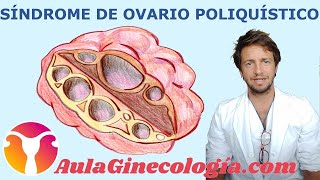 SÍNDROME de OVARIO POLIQUÍSTICO causas síntomas y diagnóstico  Ginecología y Obstetricia [upl. by Cowden248]