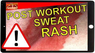 How To Treat Sweat Rash [upl. by Slaohcin]