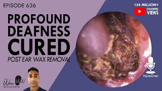 Cheapest Safest Fastest Way to Get the Ear Wax Out  Dr Alan Mandell DC [upl. by Lambart]