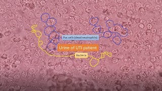 Urine of UTI patient under the Microscope [upl. by Alfonzo]