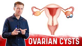 Ovarian Cysts Causes Symptoms amp Natural Treatment – DrBerg [upl. by Pasquale]