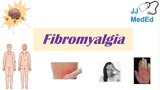 Fibromyalgia  Symptoms Associated Conditions Diagnosis Treatment [upl. by Martha]