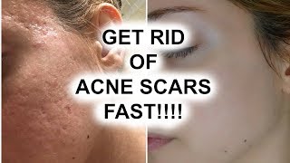 HOW TO GET RID OF ACNE SCARS  Pershii [upl. by Sabra57]