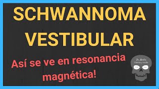 Acoustic Neuroma Vestibular Schwannoma Dr Michael Seidman MD [upl. by Middle]