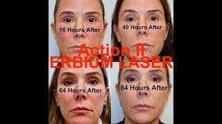 Action II Erbium Laser Resurfacing  Stepbystep procedure start to finish with Dr Weiner [upl. by Izaak]