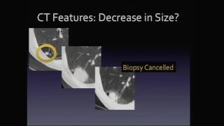 Lung cancer treatment  Respiratory system diseases  NCLEXRN  Khan Academy [upl. by Nomled416]