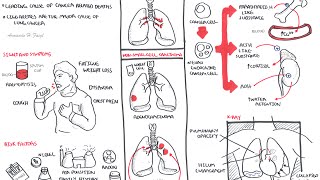 Lung Cancer  Overview [upl. by Airrat]