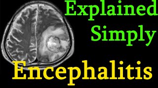 Encephalitis  brain inflammation  Symptoms causes prognosis Treatment explained simply [upl. by Asseralc]