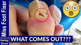 How to Treat Paronychia by Miss Foot Fixer Marion Yau [upl. by Nichole108]