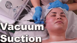 Vacuum suction facial treatment  avoid pore bruising step by step demo 2021 [upl. by Urial]