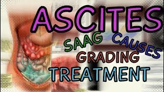 What are Ascites Transudate vs Exudate  SAAG  Fluid Wave Test  Shifting Dullness  Treatment [upl. by Einnoj]