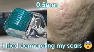 I tried dermarolling my ACNE SCARS  Demo  Review [upl. by Teirrah544]