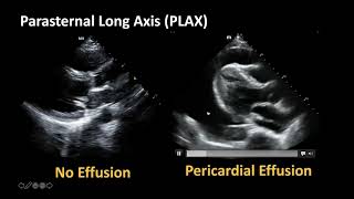 Cardiac Ultrasound Basic Pathology [upl. by Hahcim]