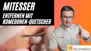 Mitesser entfernen mit Komedonenquetscher Wie geht das  Dr Kasten Hautmedizin in Mainz mitesser [upl. by Butch]